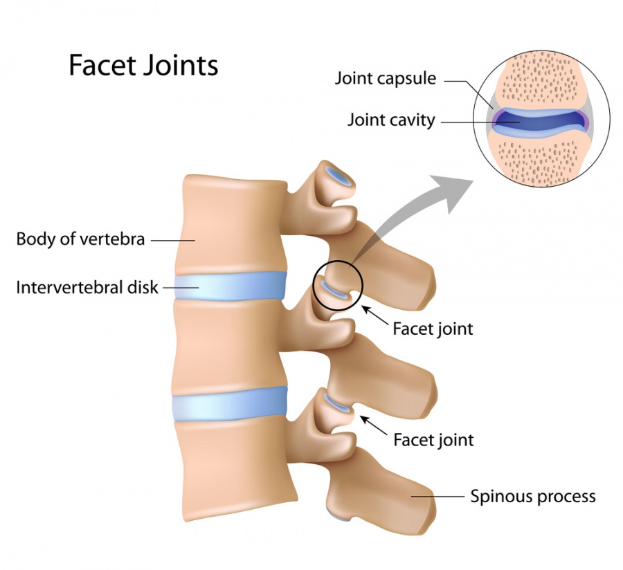 Facet Joint Arthritis