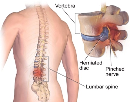 Disc Disease/Herniation