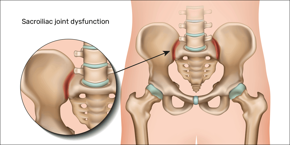 Sacroiliac Joint Inflammation